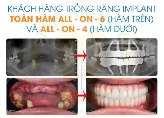 trồng răng implant toàn hàm