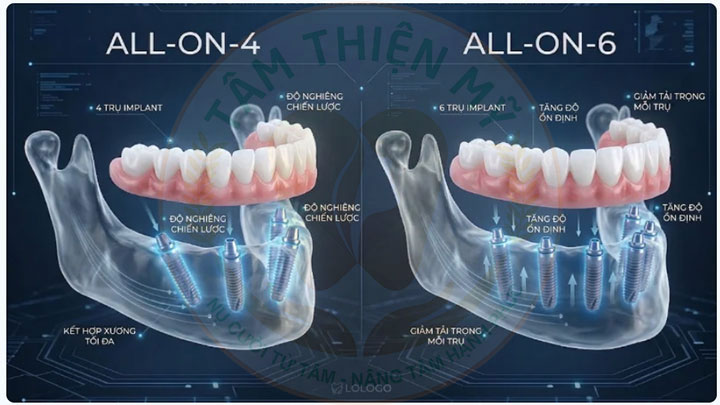 Implant toàn hàm - phục hình thay thế răng mất toàn bộ 2 implant toàn hàm
