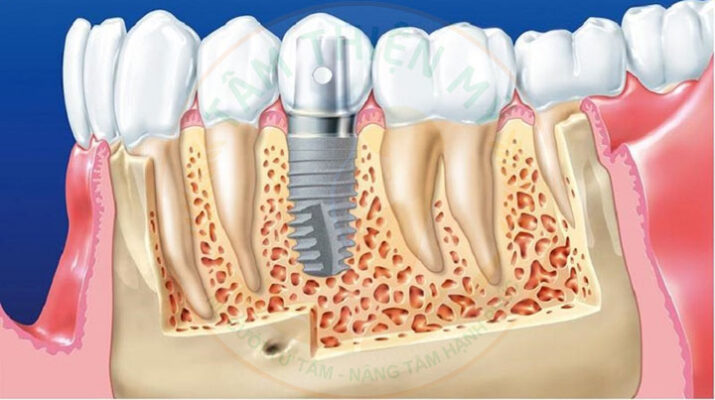 Giải pháp cấy ghép Implant cho bệnh nhân có bệnh nền tại Tâm Thiện Mỹ