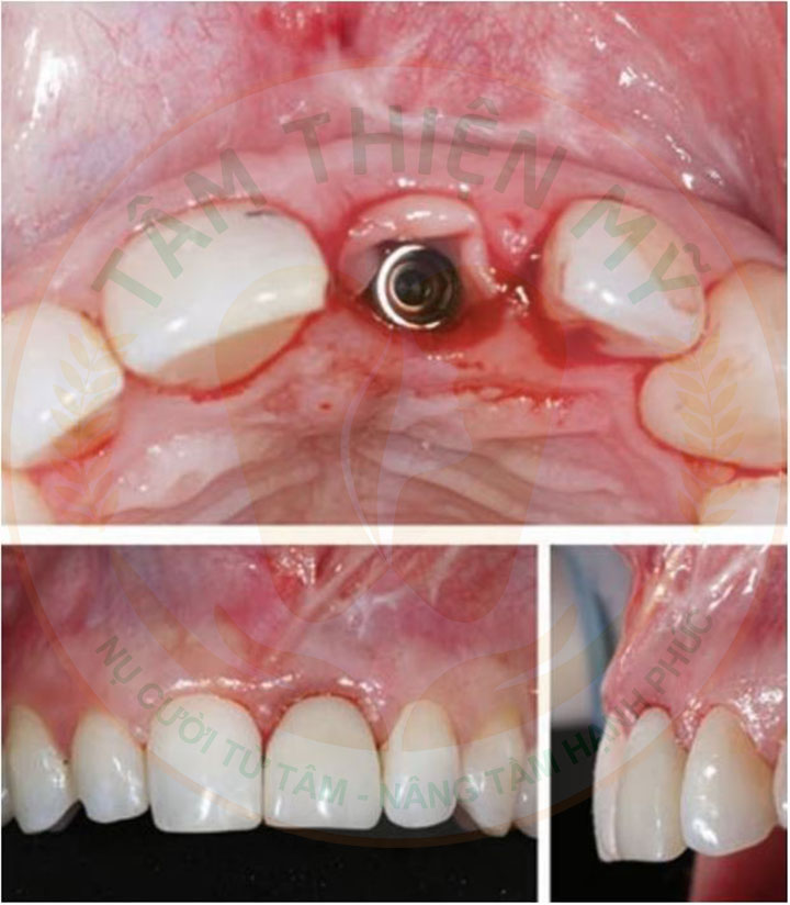 PRF trong cấy ghép Implant