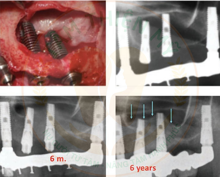 màng PRF trong cấy ghép Implant