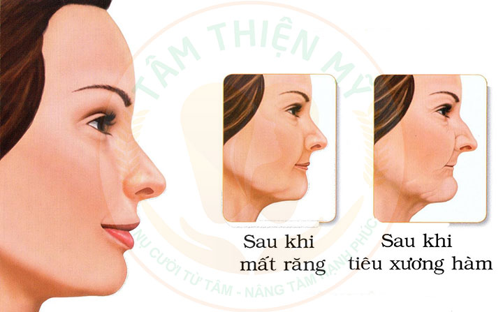Trồng răng Implant càng sớm - lợi ích dài lâu 2 Trồng răng Implant sớm giúp ngăn chặn tiêu xương hàm
