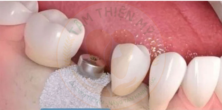 màng xương sử dụng trong cấy ghép răng Implant
