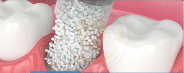 màng xương sử dụng trong cấy ghép răng Implant