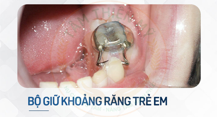 Có nên trồng răng Implant cho trẻ em? Giải pháp cho trẻ em bị mất răng 6 hàm giữ khoảng cho trẻ em bị mất răng