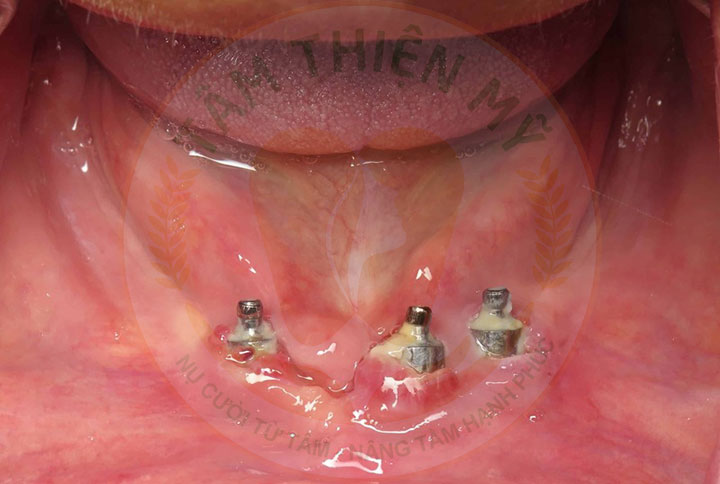 Implant xương bướm - phục hình không ghép xương, nâng xoang 5 răng implant bị nhiễm trùng