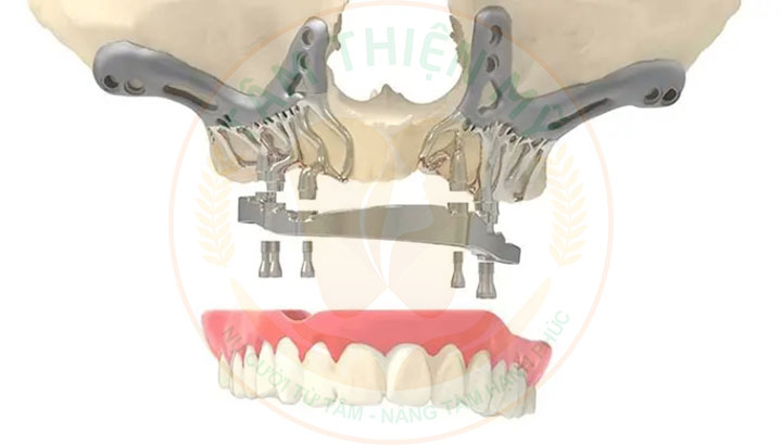 implant cá nhân hóa