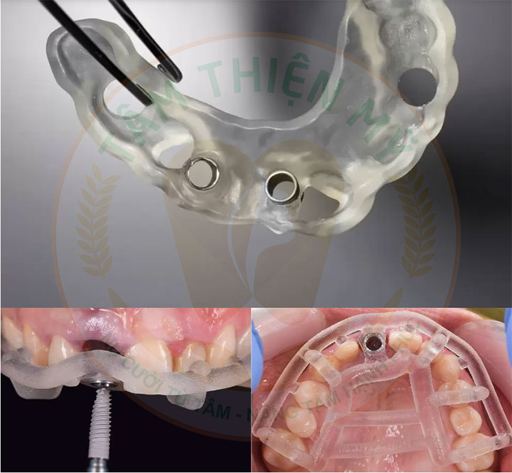 cấy ghép implant cá nhân hóa