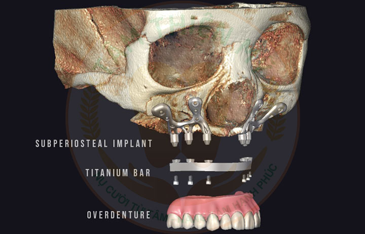 Implant cá nhân hóa