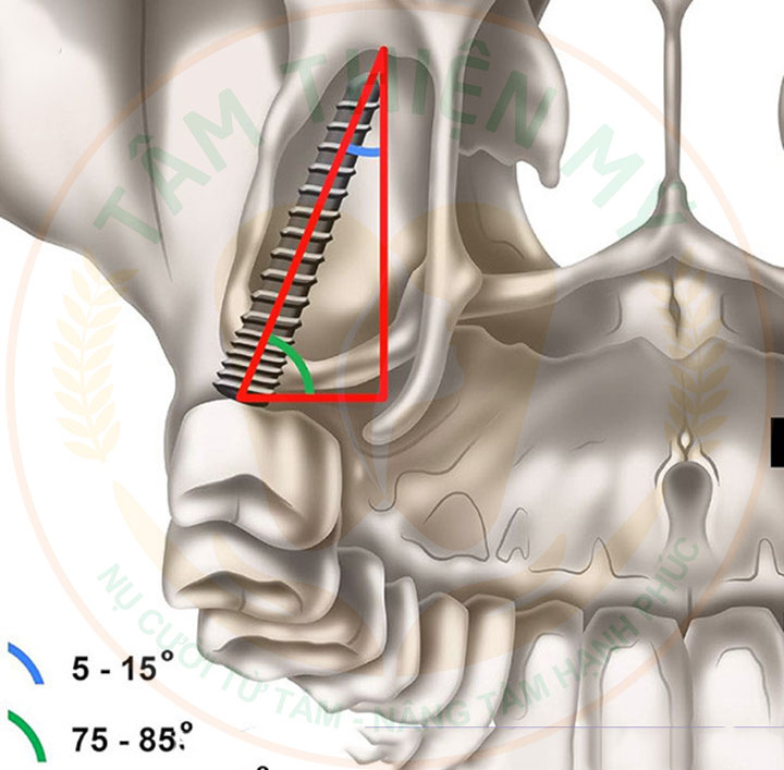 Implant xương bướm - phục hình không ghép xương, nâng xoang 2 Implant xương bướm là thế nào