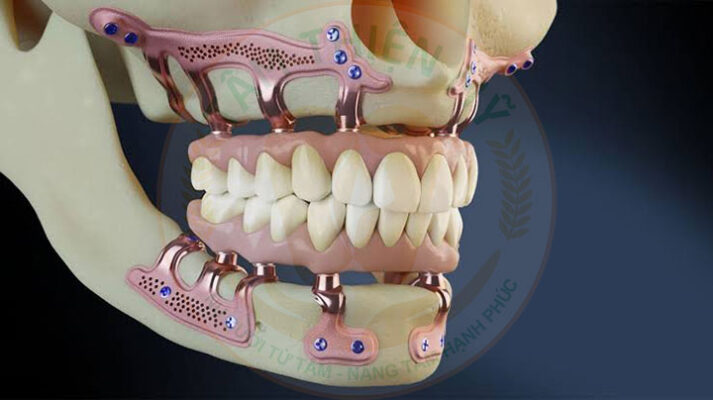 cấy ghép Implant dưới màng xương