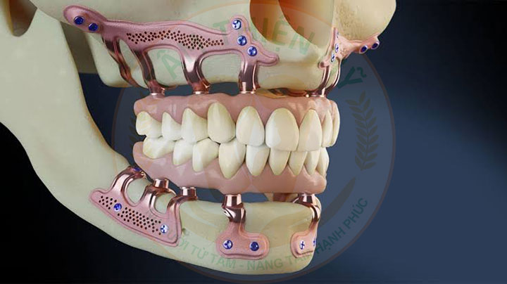 cấy ghép Implant dưới màng xương