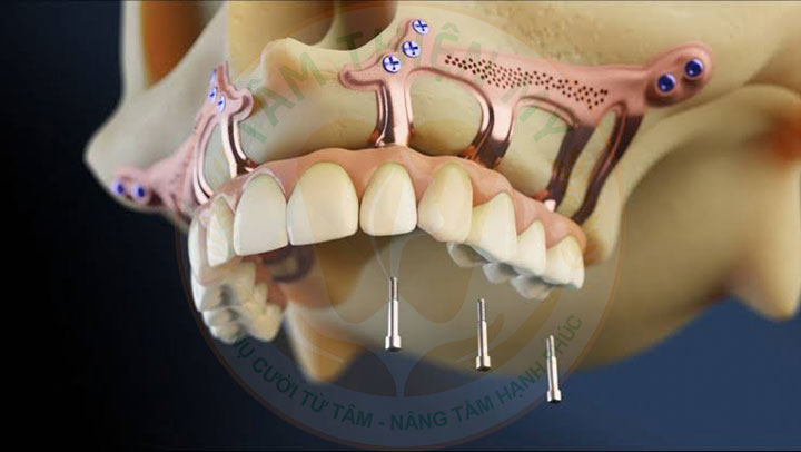 cấy ghép Implant dưới màng xương