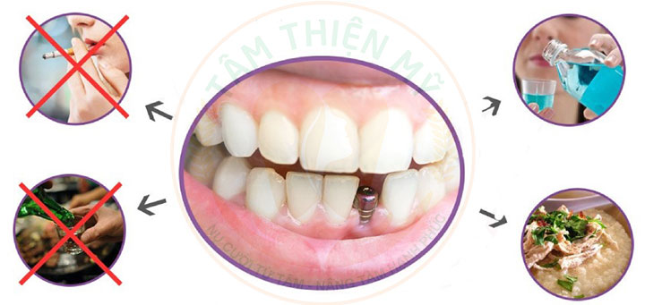 bệnh nhân cấy ghép Implant dưới màng xương