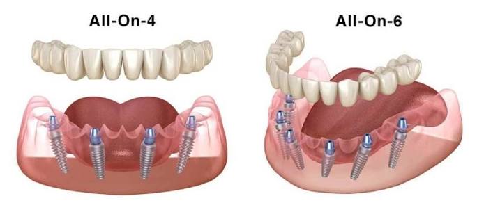 Implant toàn hàm - phục hình thay thế răng mất toàn bộ 4 cấy ghép implant toàn hàm