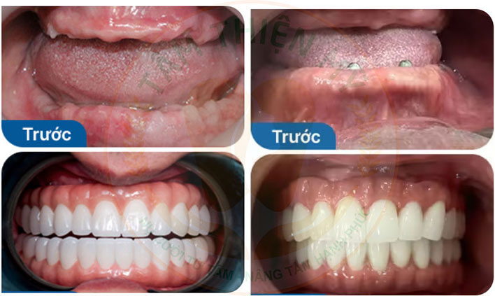 Implant toàn hàm - phục hình thay thế răng mất toàn bộ 3 implant toàn hàm cho đối tượng nào