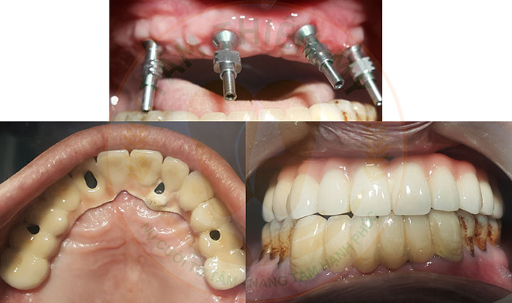 Implant toàn hàm - phục hình thay thế răng mất toàn bộ 8 Cấy implant toàn hàm giá bao nhiêu