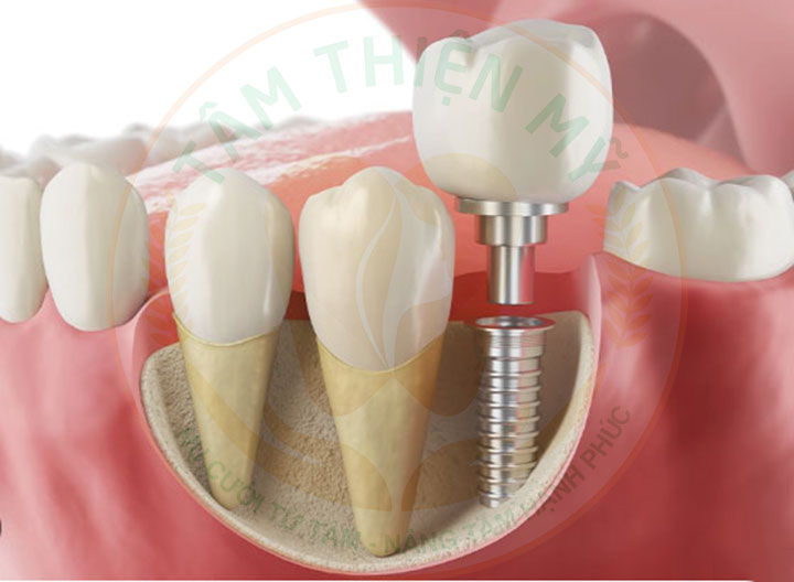 cấy ghép implant truyền thống