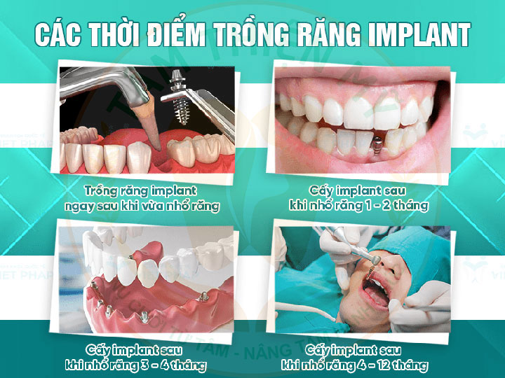 Trồng răng Implant càng sớm - lợi ích dài lâu 8 Thời điểm trồng răng Implant nào là tốt nhất