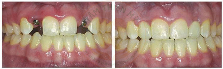 Kỹ thuật cấy ghép răng Implant tại Tâm Thiện Mỹ có gì HOT? 5 kỹ thuật cấy ghép implant
