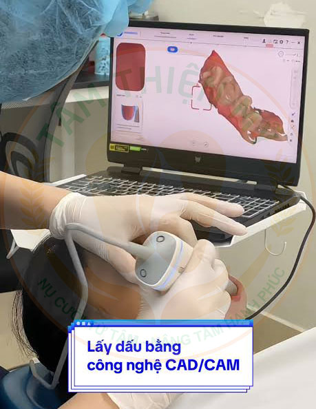lấy dấu bằng công nghệ cad cam cho độ chính xác cao