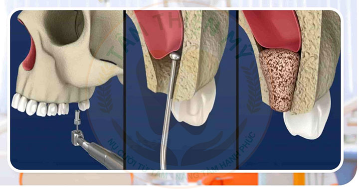 Nâng xoang trong cấy ghép Implant - Giải pháp phục hồi xương hàm hiệu quả 3 Nâng xoang trong cấy ghép Implant
