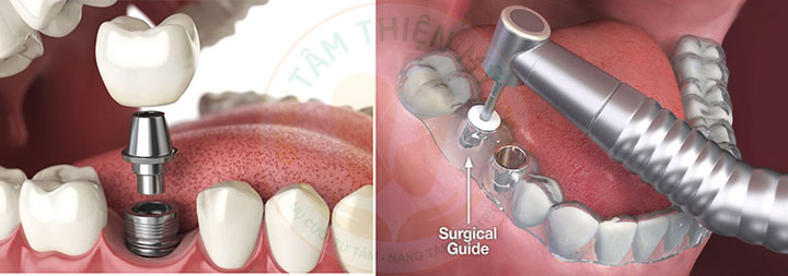 cấy ghép Implant cá nhân hóa và Implant thông thường