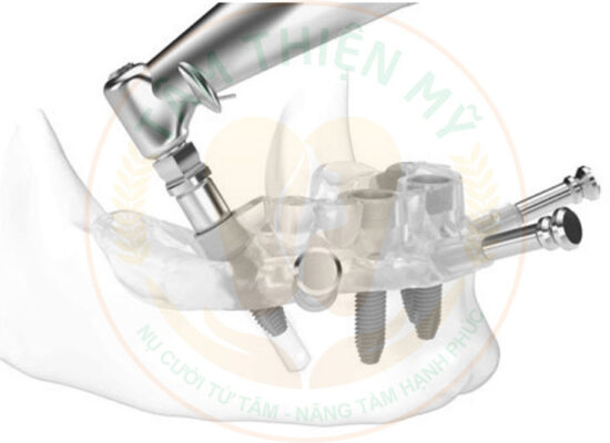 Máy CT Cone Beam 3D - Bước đầu quyết định 1 ca Implant thành công 11 cấy trụ implant