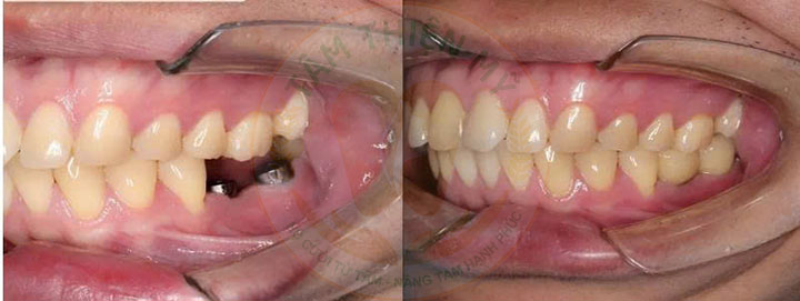 Kỹ thuật cấy ghép răng Implant tại Tâm Thiện Mỹ có gì HOT? 3 mất răng gây khó ăn nhai