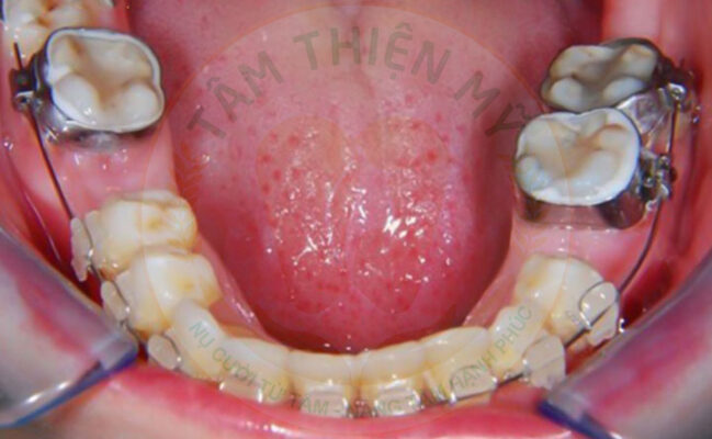 Có nên trồng răng Implant cho trẻ em? Giải pháp cho trẻ em bị mất răng 7 Chỉnh nha trước khi rồng răng Implant cho trẻ em