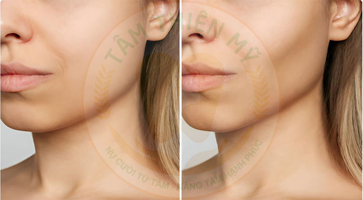 Trồng răng Implant càng sớm - lợi ích dài lâu 3 Trồng răng Implant sớm giúp duy trì tính thẩm mỹ tự nhiên