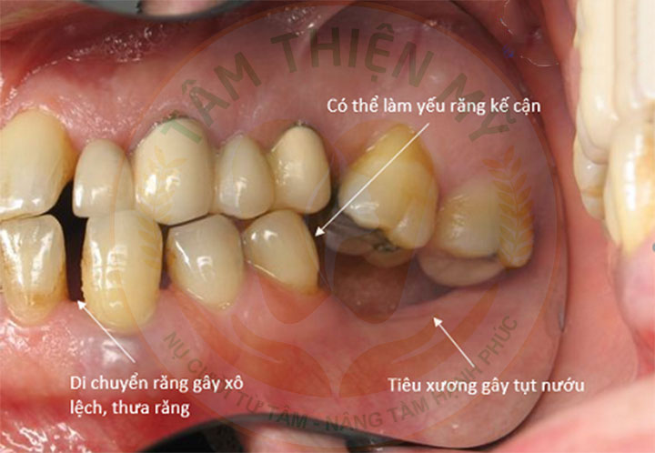 Trồng răng Implant càng sớm - lợi ích dài lâu 4 Trồng răng Implant sớm giúp răng không bị xô lệch