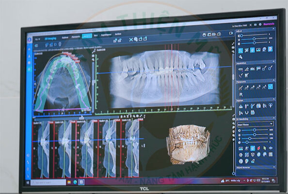 Máy CT Cone Beam 3D - Bước đầu quyết định 1 ca Implant thành công 9 máy CT Cone Beam 3D trong cấy ghép Implant