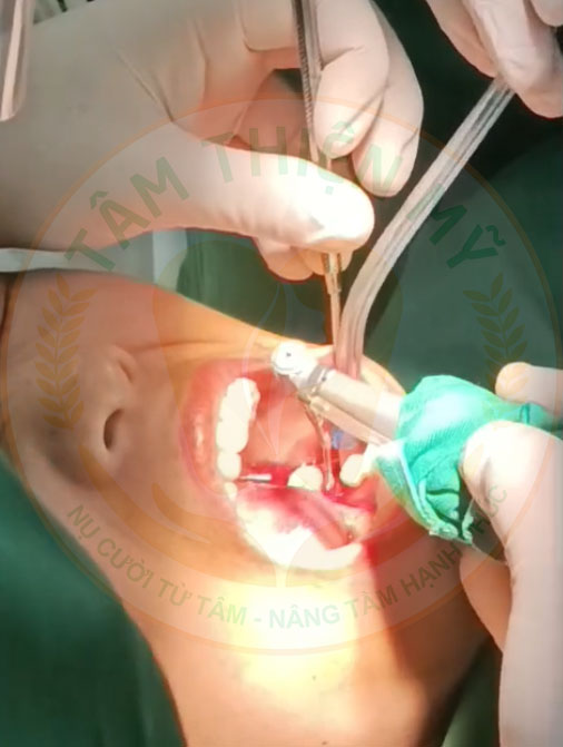 máy khoan đặt trụ implant