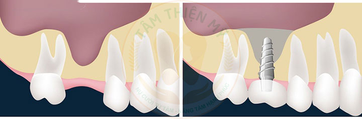 Nâng xoang trong cấy ghép Implant - Giải pháp phục hồi xương hàm hiệu quả 9 Nâng xoang trong cấy ghép Implant