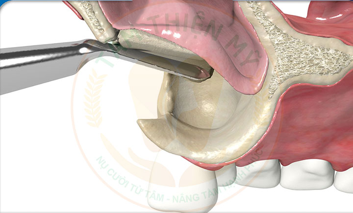 Nâng xoang trong cấy ghép Implant - Giải pháp phục hồi xương hàm hiệu quả 5 nâng xoang trong cấy ghép Implant