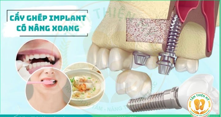 Nâng xoang trong cấy ghép Implant - Giải pháp phục hồi xương hàm hiệu quả 11 Nâng xoang trong cấy ghép Implant
