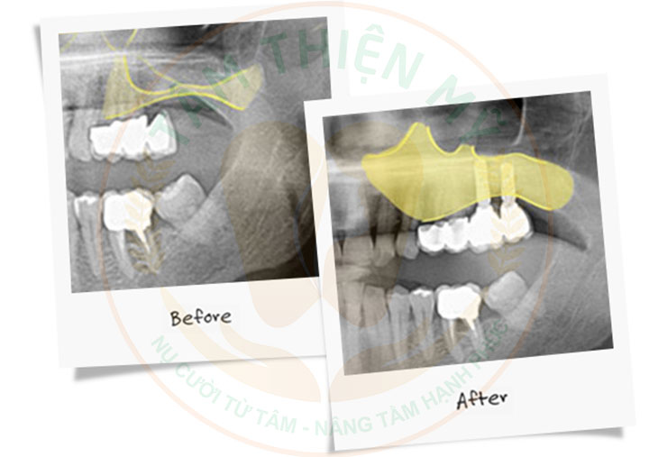 Nâng xoang trong cấy ghép Implant - Giải pháp phục hồi xương hàm hiệu quả 2 Nâng xoang trong cấy ghép Implant