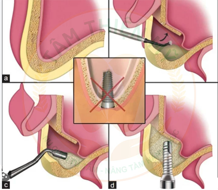 Nâng xoang trong cấy ghép Implant