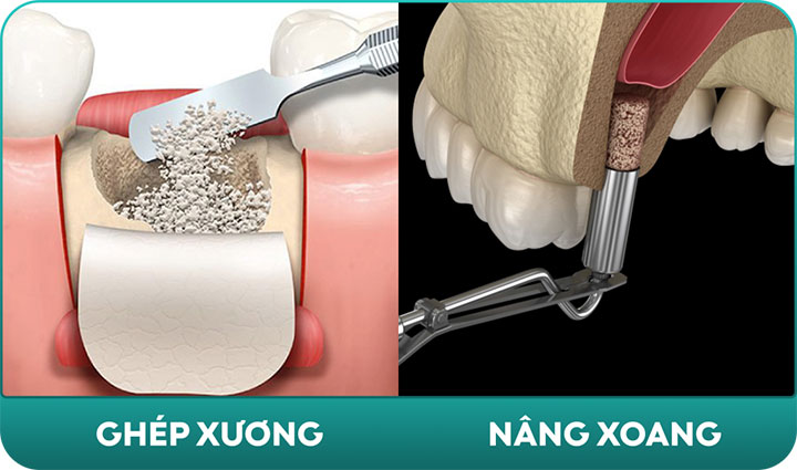 nâng xoang và ghép xương