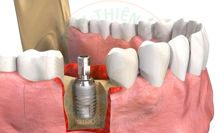 nâng xoang trong cấy ghép Implant