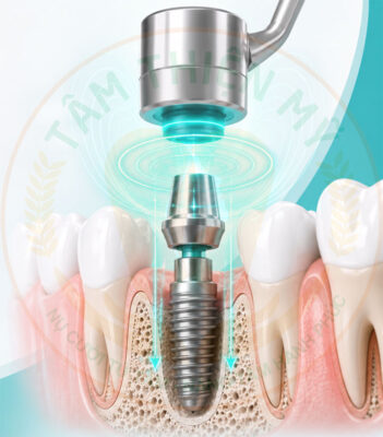 cấy ghép Implant từ tính tại Nha Khoa Tâm Thiện 