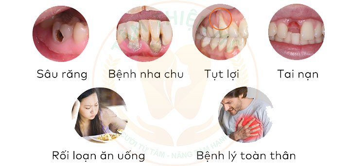 nguyên nhân gây mất răng