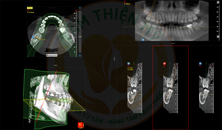 Máy CT Cone Beam 3D - Bước đầu quyết định 1 ca Implant thành công 6 nhổ răng khôn