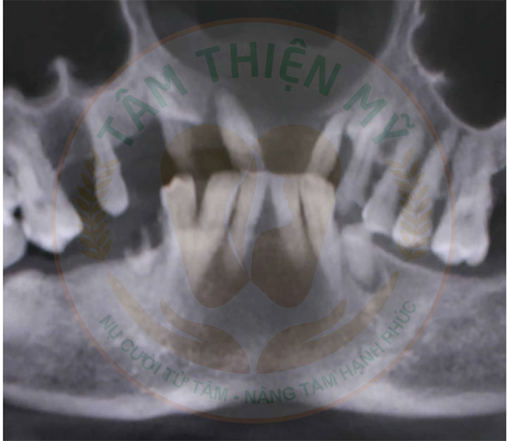 trồng răng giả Implant cho người mất răng lâu năm