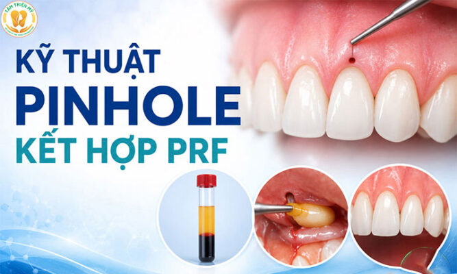 prf trong cấy ghép implant