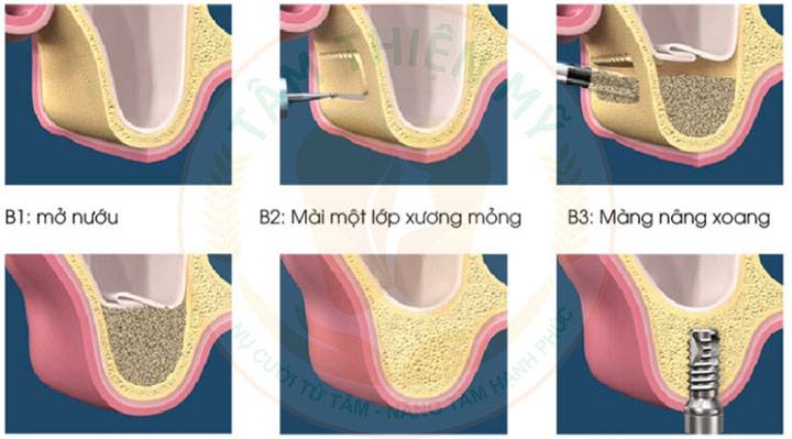 Nâng xoang trong cấy ghép Implant - Giải pháp phục hồi xương hàm hiệu quả 8 nâng xoang hở trong cấy ghép Implant