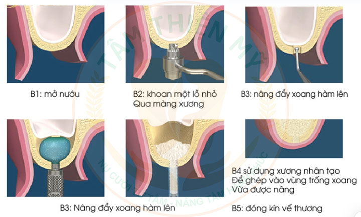 Nâng xoang trong cấy ghép Implant - Giải pháp phục hồi xương hàm hiệu quả 6 nâng xoang kín trong cấy ghép Implant