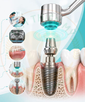 Quy trình cấy ghép Implant từ tính tại Nha Khoa Tâm Thiện 