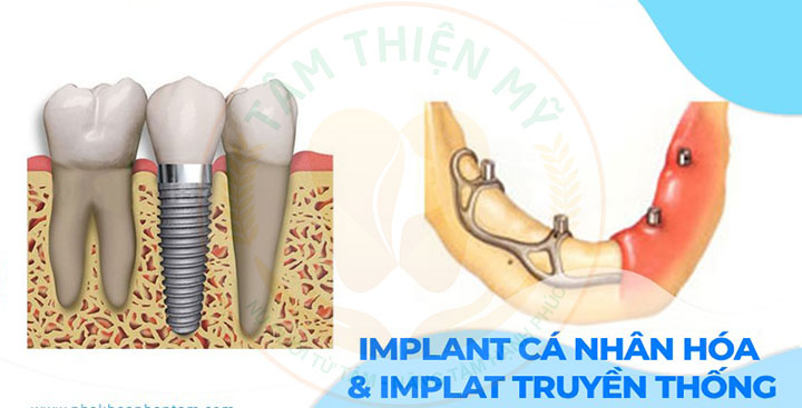 Cấy ghép Implant cá nhân hóa và Implant truyền thống